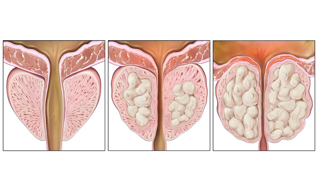 etapas del cancer de prostata
