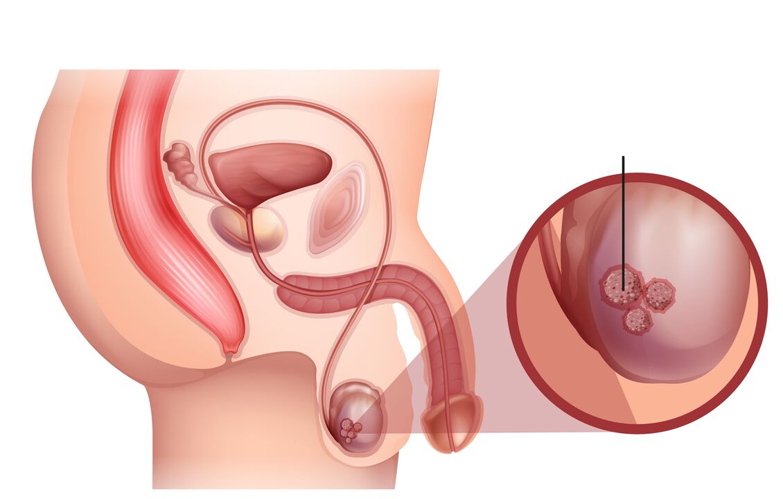 signos de cáncer de próstata