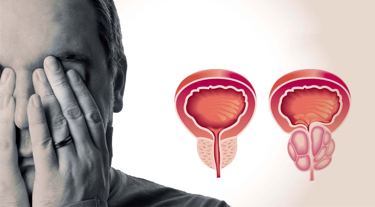 prostatitis crónica en hombres