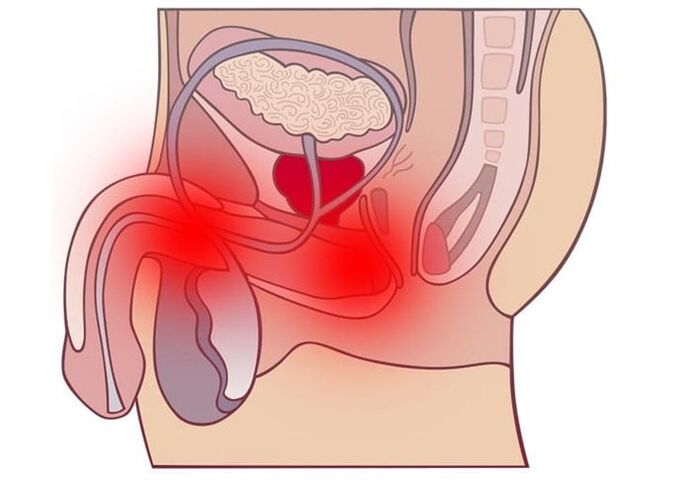 métodos de tratamiento de la prostatitis