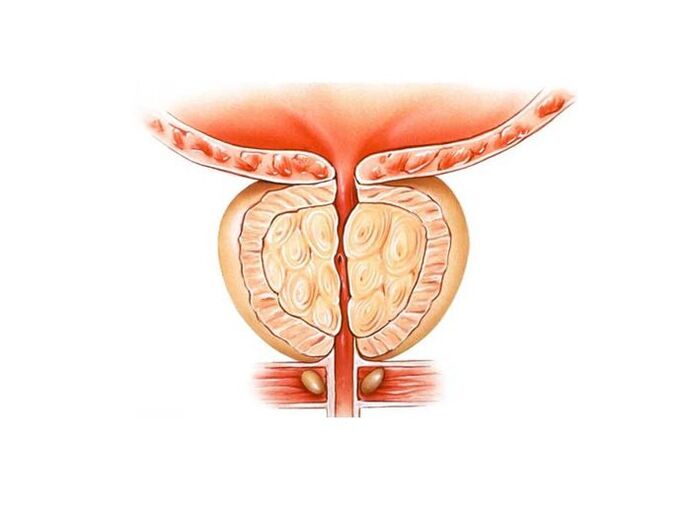 tratamiento de la prostatitis con remedios caseros